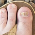 Schimmelnagels: symptomen wit-gele, groene of bruine nagels