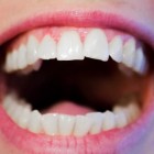 Tandvleesontsteking: Oorzaak en behandeling