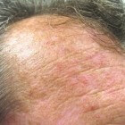 Plekjes op de huid, ruw en lichtbruin: oorzaken en symptomen
