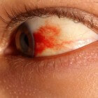 Bloed in het oog: oorzaken bloeduitstorting op het oogwit