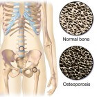 Osteoporose behandeling: medicatie, injecties en voeding