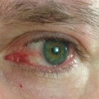 Rode ogen: oorzaken van een rood oog of bloeddoorlopen ogen