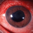Uveïtis: Ontsteking uvea, middelste laag oog (oogontsteking)