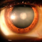 Congenitale cataract (staar): Vertroebeling van de ooglens