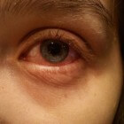 Oogontsteking: symptomen, oorzaak, behandeling ontstoken oog