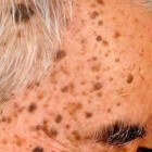 Zonnevlekken gezicht: ontstaan en verwijderen bruine vlekken