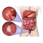 Dikkedarmkanker: oorzaak en behandeling tumoren dikke darm