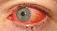 Bij rode ogen en pijn is het verstandig om meteen een oogarts op te zoeken / Bron: Marco Mayer, Wikimedia Commons (CC BY-SA-4.0)