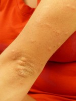 Netelroos ((jeukende) bultjes op de huid) is één van de mogelijke symptomen / Bron: Hans, Pixabay