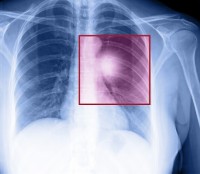 Aanhoudende droge hoest door longkanker / Bron: Muratart/Shutterstock.com
