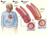 Slagaderverkalking / Bron: National Heart Lung and Blood Insitute (NIH), Wikimedia Commons (Publiek domein)