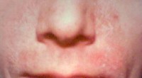 Seborrhoïsch eczeem rond de neus / Bron: Mijane, Wikimedia Commons (CC BY-SA-3.0)
