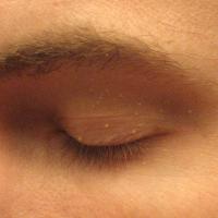 Gerstekorrels op een ooglid, zichtbaar als kleine witte puntjes op ooglid / Bron: Silver442n, Wikimedia Commons (Publiek domein)