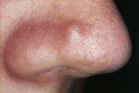Fibrous papule of the nose / Bron: M. Sand et al., Wikimedia Commons (CC BY-2.0)