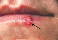 Gezwollen lymfeklieren in de hals door een koortslip / Bron: Publiek domein, Wikimedia Commons (PD)