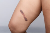 Een keloïd op het been / Bron: WEERACHAT/Shutterstock.com