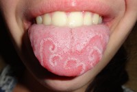 Pijn aan de tong door landkaarttong / Bron: Martanopue , Wikimedia Commons (CC BY-SA-3.0)