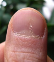 Milde nagelpsoriasis / Bron: Seenms, Wikimedia Commons (CC BY-SA-3.0)