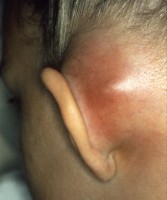 Mastoïditis geeft zwelling achter de oren / Bron: B. Welleschik, Wikimedia Commons (CC BY-SA-3.0)