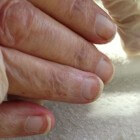Terry's nagels: Nagelafwijking met band aan rand van nagels