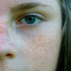 Abnormale huidpigmentatie, Pityriasis rosea en Ichthyosis