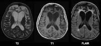 MRI-scan ziekte van Pick / Bron: Mikhail Kalinin, Wikimedia Commons (CC BY-SA-3.0)